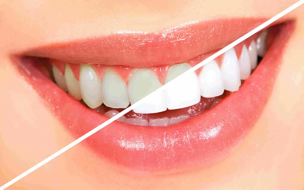 Duration and Care for Teeth Whitening